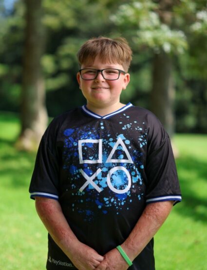 Charlie, 11, burns